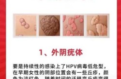 感染奥密克戎有什么症状和感觉（感染hpv有什么症状）