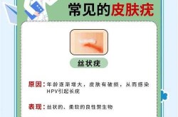 身上5种疣可能是HPV感染（身上长疣就一定是hpv感染了吗）